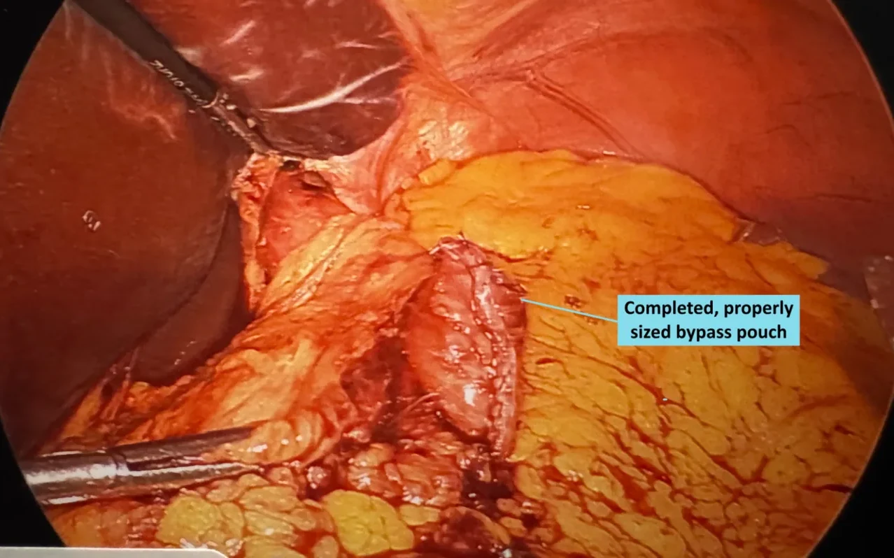 Vista laparoscópica de la bolsa de bypass gástrico terminada y de tamaño correcto tras la conversión de manga a bypass, realizada por el Dr. Matthew Fitzer en Virginia.