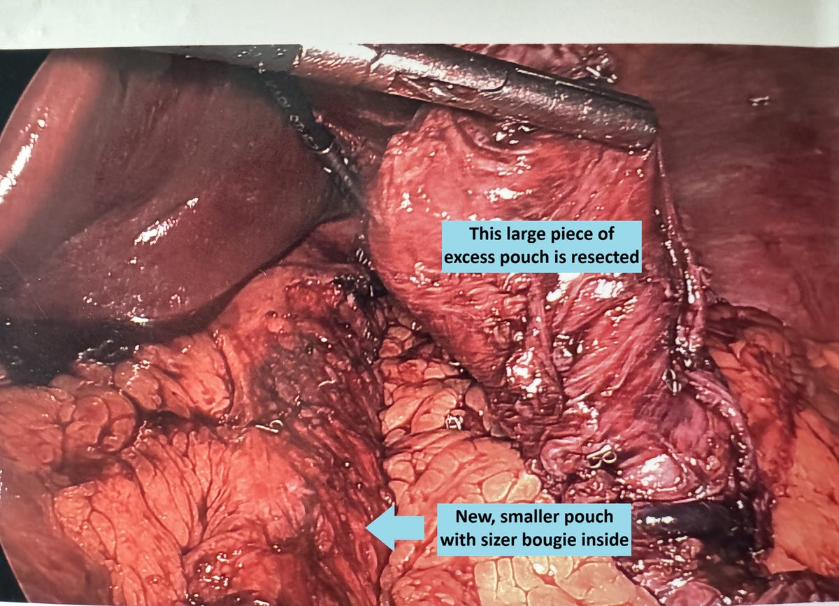 Laparoscopic gastric bypass pouch revision in Northern Virginia showing excess pouch resection and new smaller pouch with sizer bougie