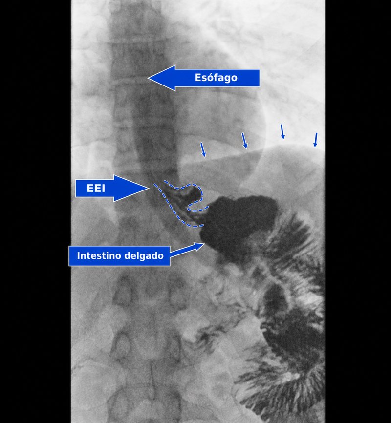 Nueva serie gastrointestinal superior después de la reparación de la hernia hiatal y la conversión a bypass gástrico, con rótulos para el esófago, el esfínter esofágico inferior y el intestino delgado, que muestra todo el reservorio gástrico por debajo del diafragma y sin reflujo