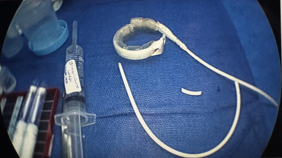 Una LAP-BAND retirada por el Dr. Fitzer y separada en cuatro piezas