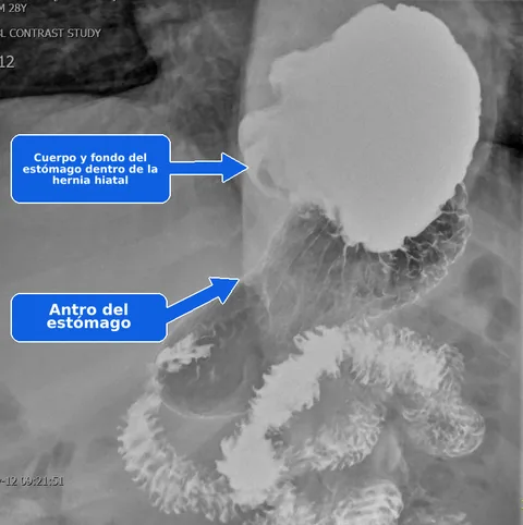 Estudio gastrointestinal superior con contraste anotado que muestra el cuerpo y fondo del estómago dentro de una hernia hiatal gigante tipo IV, con el antro gástrico por debajo.