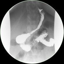 Post-operative imaging of a slim, tubular gastric sleeve after laparoscopic sleeve gastrectomy by Dr. Fitzer