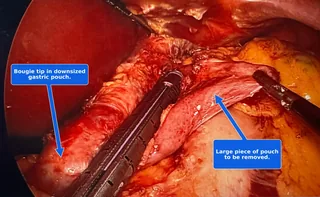 Laparoscopic gastric bypass pouch revision in progress: a bougie sizer marks the downsized pouch while a stapler removes the large excess piece of gastric pouch.