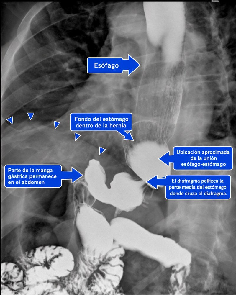 Serie gastrointestinal superior anotada de otra paciente con manga gástrica y hernia hiatal tipo III; señala el esófago, el fondo gástrico herniado, la unión gastroesofágica aproximada, el estrechamiento en el diafragma y la parte de la manga que permanece en el abdomen.