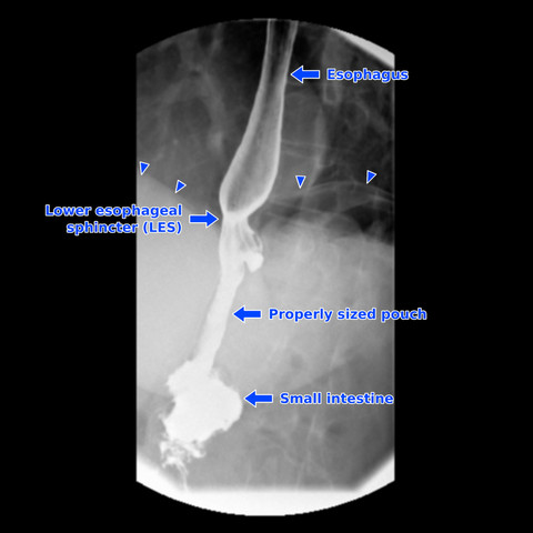 Annotated upper GI study of a normal gastric bypass showing the esophagus, lower esophageal sphincter, narrow pouch, small intestine, and triangles marking the top edge of the diaphragm