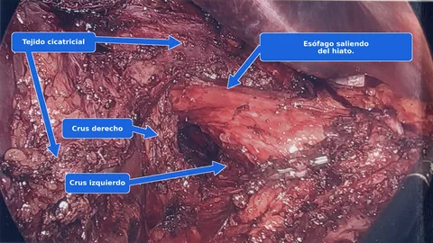 Vista laparoscópica del tejido cicatricial que cubre los pilares y el esófago durante una nueva reparación de hernia hiatal después de una reparación previa con malla.