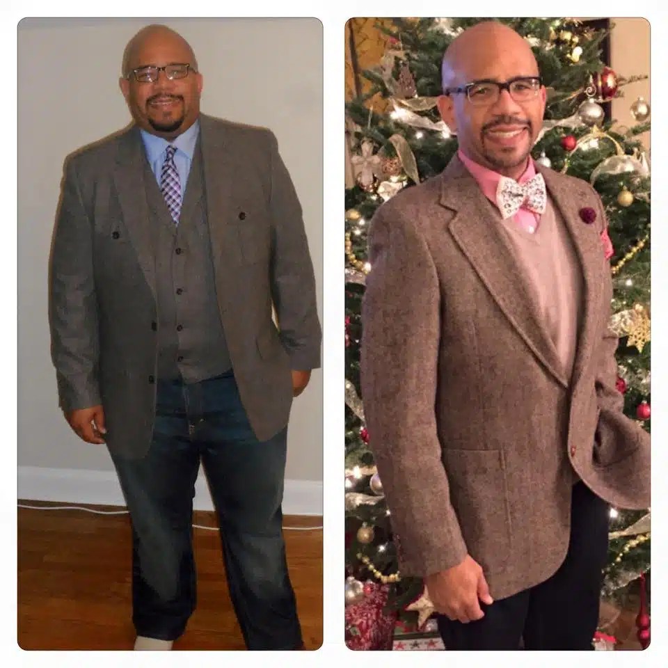 Bariatric patient weight-loss journey before and after