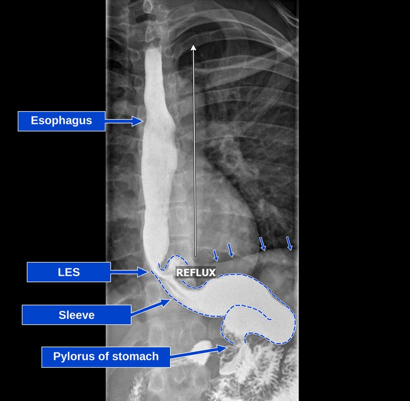 Upper GI series of a sleeve patient with a small hiatal hernia and severe reflux, labeled with the esophagus, lower esophageal sphincter, sleeve, and pylorus, showing contrast and a small pouch of the sleeve above the diaphragm