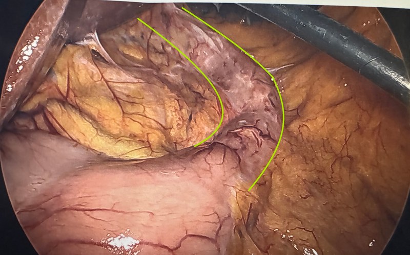 Laparoscopic view of a normal gastric sleeve outlined in green during gallbladder surgery five years after sleeve gastrectomy