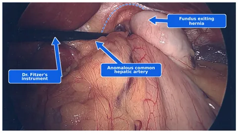 Laparoscopic view before type II hiatal hernia repair, labeling the stomach fundus exiting the hernia and an anomalous common hepatic artery.