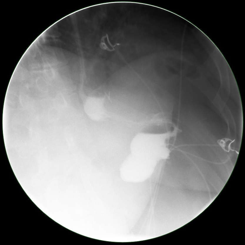 Imaging study of a proper sleeve gastrectomy performed by Dr. Fitzer