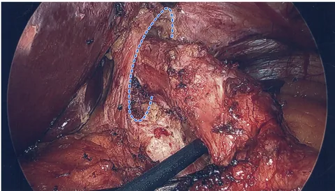 Laparoscopic view during redo hiatal hernia repair, with the hiatus outlined by a dashed blue line and thick scar tissue around the esophagus.