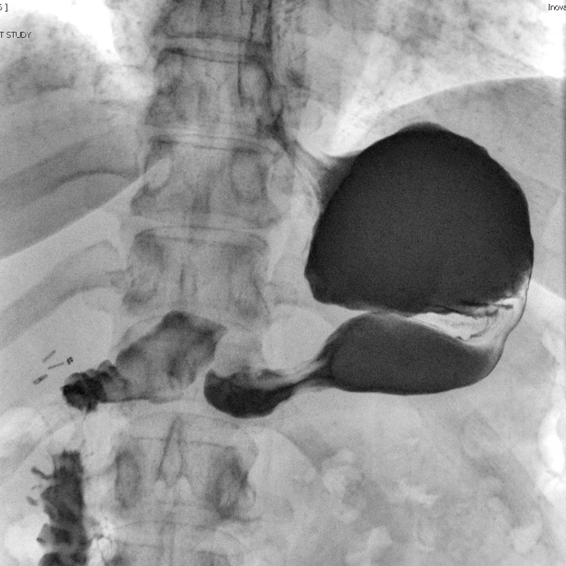 Imaging study of an over-large amateur sleeve gastrectomy