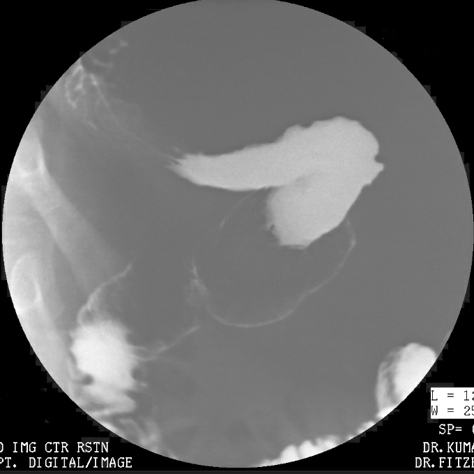 Imaging study of a proper sleeve gastrectomy performed by Dr. Fitzer