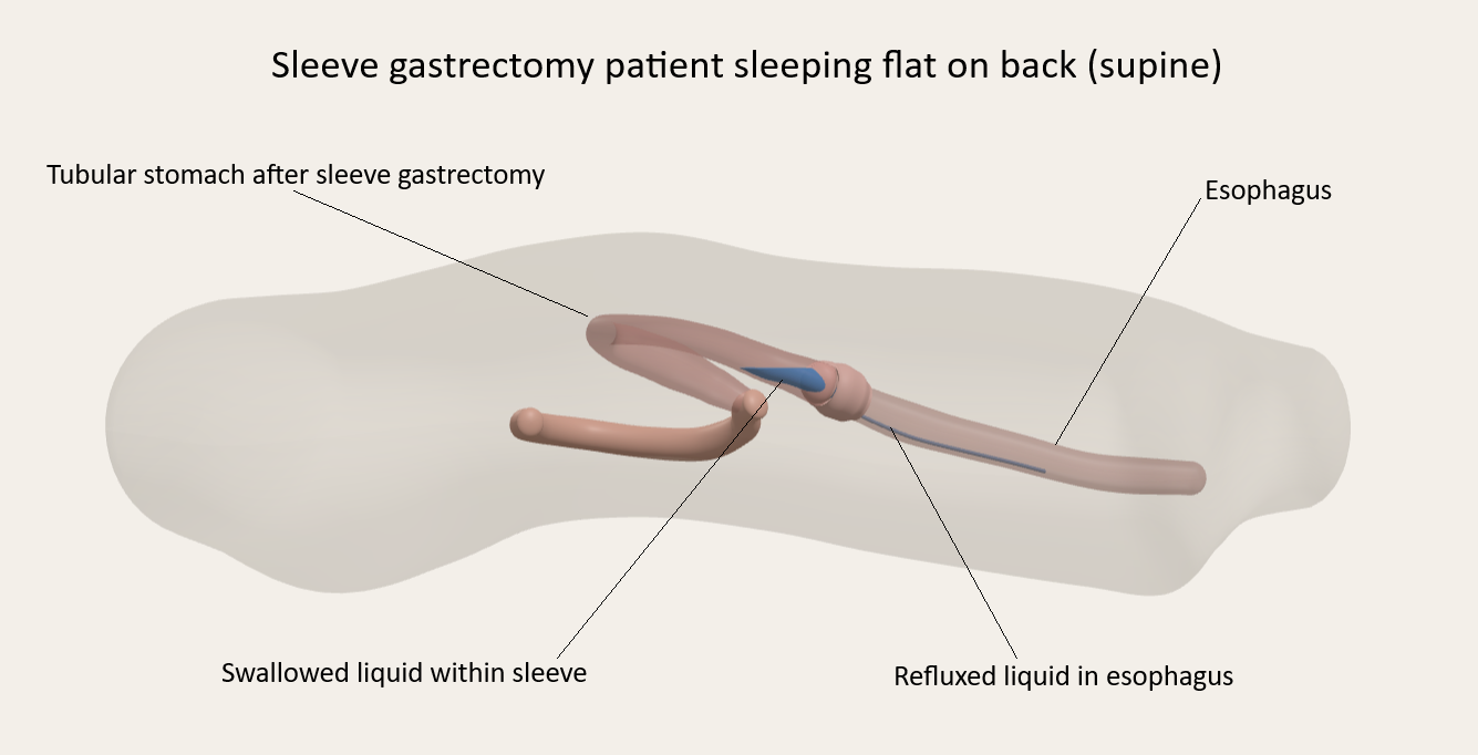 Medical illustration of a sleeve gastrectomy patient lying flat on their back, showing the tubular stomach, swallowed liquid within the sleeve, and refluxed liquid in the esophagus