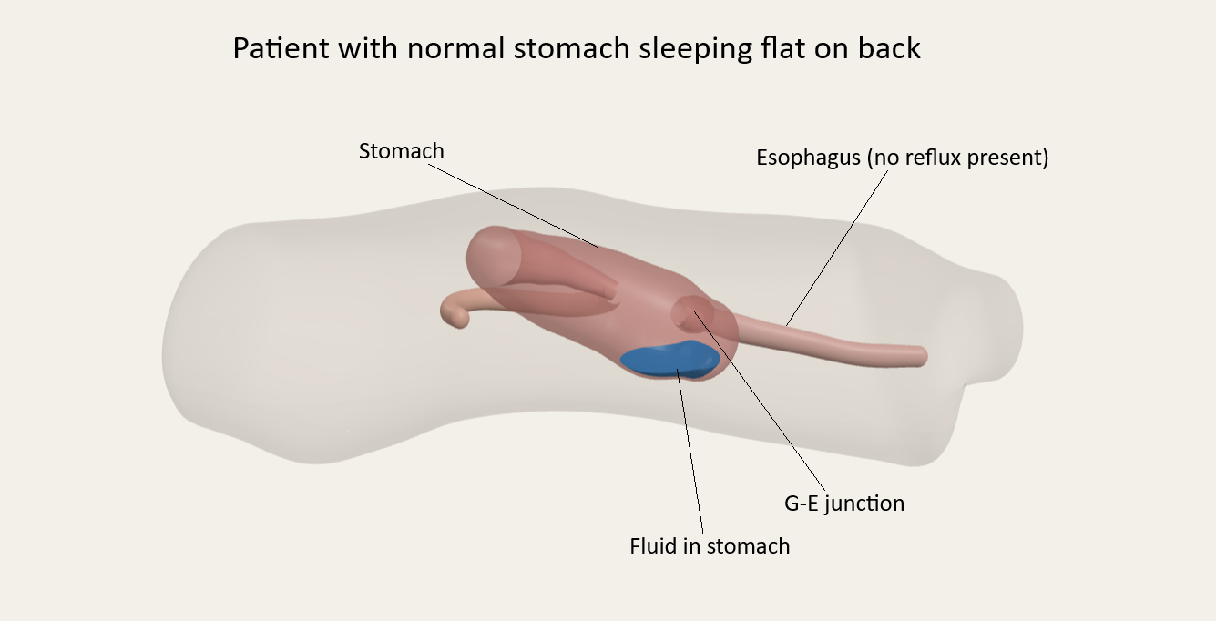 Medical illustration of a patient with a normal stomach lying flat on their back, showing the stomach, esophagus, and gastroesophageal junction with fluid remaining in the stomach and no reflux
