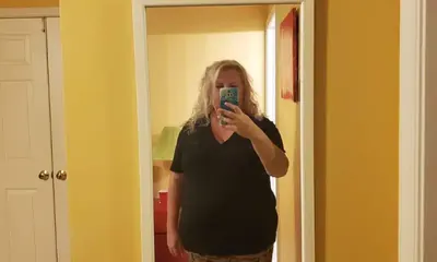 Shona Gardner before weight-loss surgery with Dr. Matthew Fitzer
