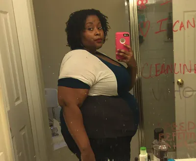 Tiffany W. before weight-loss surgery with Dr. Matthew Fitzer