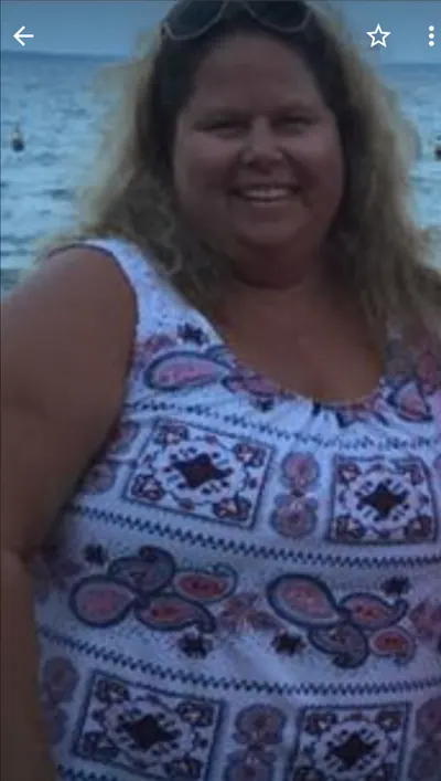 Shelly T. before weight-loss surgery with Dr. Matthew Fitzer