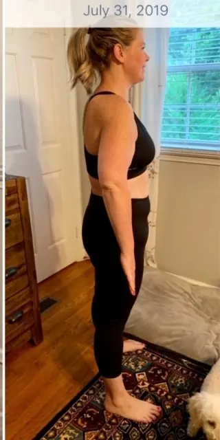 An anonymous patient's one-year change after weight-loss surgery with Dr. Matthew Fitzer