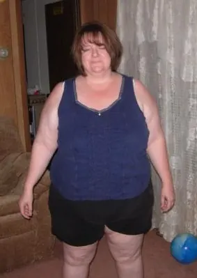 M. M. before weight-loss surgery with Dr. Matthew Fitzer