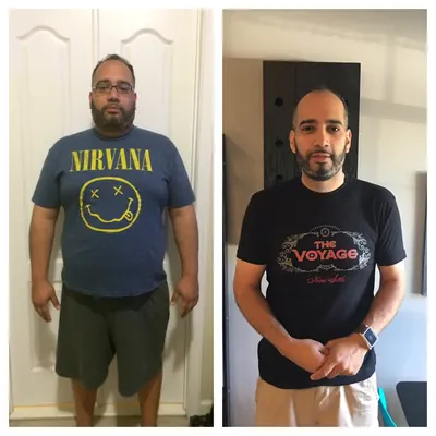 An anonymous Virginia Bariatric patient — weight-loss progress after bariatric surgery at Virginia Bariatric Center