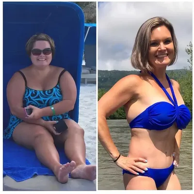 An anonymous bariatric surgery patient’s side-by-side result — weight-loss progress after bariatric surgery at Virginia Bariatric Center