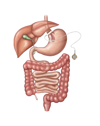 Adjustable gastric banding weight loss surgery