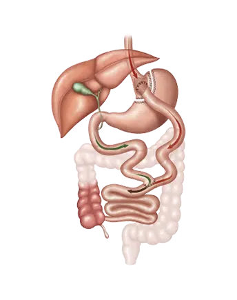 Illustration of gastric bypass surgery