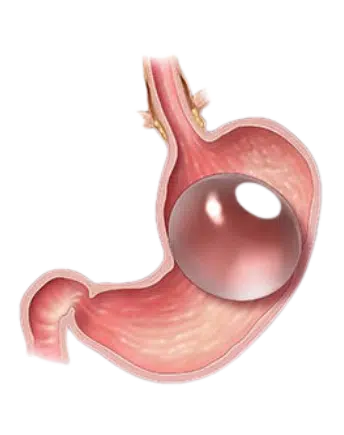 Intragastric Balloon for weight loss