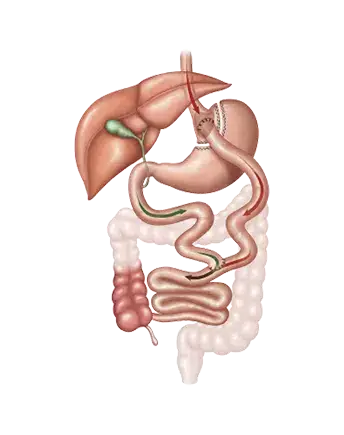 Illustration of gastric bypass surgery