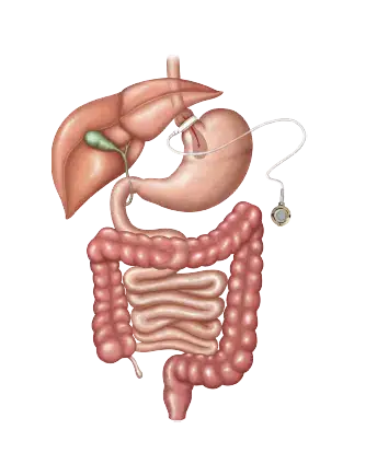 Adjustable gastric bypass