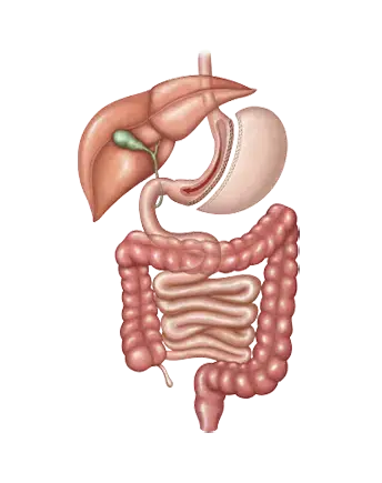 Illustration of sleeve gastrectomy surgery